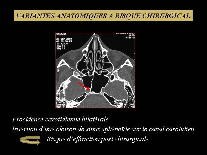 VARIANTES ANATOMIQUES A RISQUE CHIRURGICAL Procidence carotidienne bilatérale Insertion d’une cloison de sinus sphénoïde