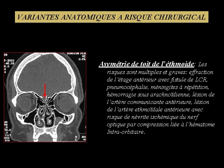 VARIANTES ANATOMIQUES A RISQUE CHIRURGICAL Asymétrie de toit de l’éthmoide: Les risques sont multiples