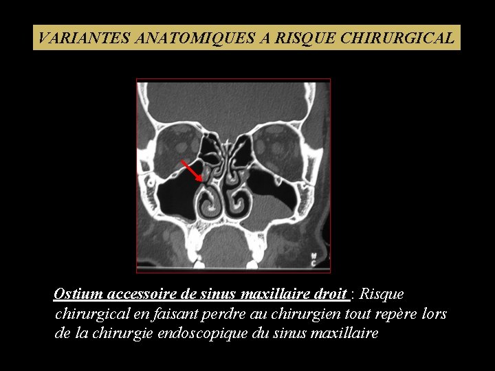 VARIANTES ANATOMIQUES A RISQUE CHIRURGICAL Ostium accessoire de sinus maxillaire droit : Risque chirurgical