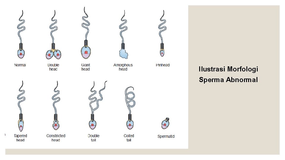 Ilustrasi Morfologi Sperma Abnormal 