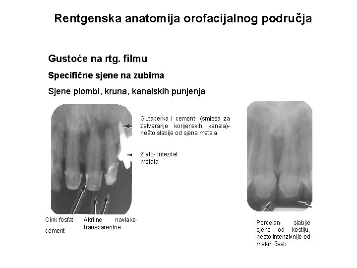 Rentgenska anatomija orofacijalnog područja Gustoće na rtg. filmu Specifične sjene na zubima Sjene plombi,