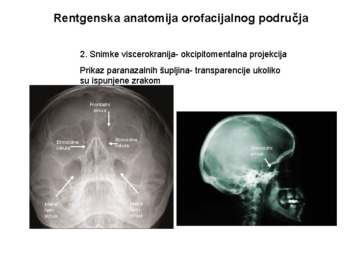 Rentgenska anatomija orofacijalnog područja 2. Snimke viscerokranija- okcipitomentalna projekcija Prikaz paranazalnih šupljina- transparencije ukoliko