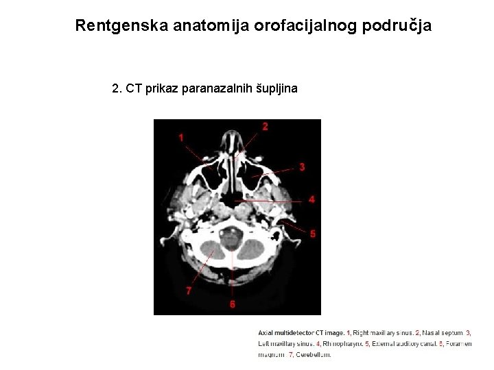 Rentgenska anatomija orofacijalnog područja 2. CT prikaz paranazalnih šupljina 
