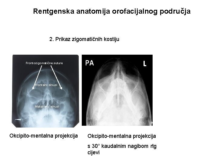 Rentgenska anatomija orofacijalnog područja 2. Prikaz zigomatičnih kostiju Frontozigomatične suture Frontalni sinusi Maksilarni sinusi