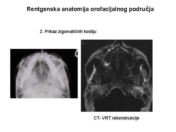 Rentgenska anatomija orofacijalnog područja 2. Prikaz zigomatičnih kostiju CT- VRT rekonstrukcije 