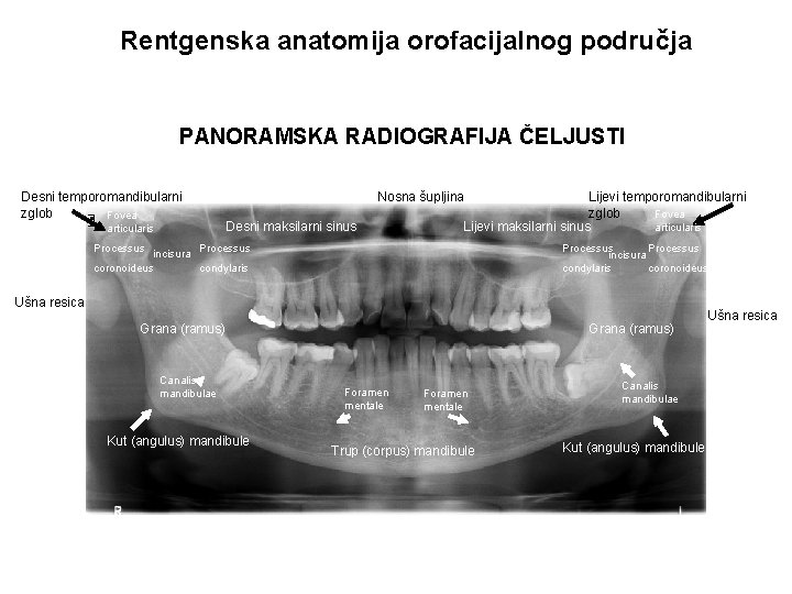 Rentgenska anatomija orofacijalnog područja PANORAMSKA RADIOGRAFIJA ČELJUSTI Desni temporomandibularni zglob Fovea articularis Nosna šupljina