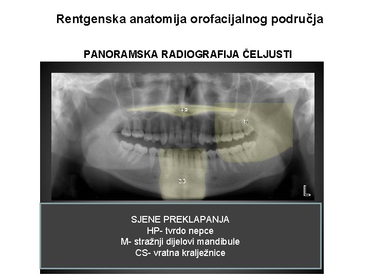Rentgenska anatomija orofacijalnog područja PANORAMSKA RADIOGRAFIJA ČELJUSTI SJENE PREKLAPANJA HP- tvrdo nepce M- stražnji