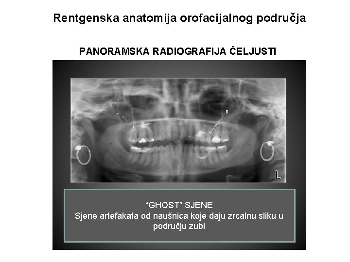 Rentgenska anatomija orofacijalnog područja PANORAMSKA RADIOGRAFIJA ČELJUSTI “GHOST” SJENE Sjene artefakata od naušnica koje