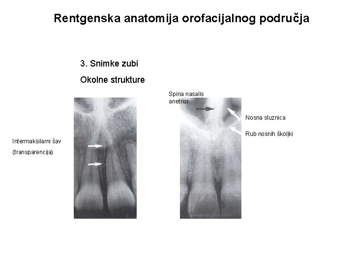 Rentgenska anatomija orofacijalnog područja 3. Snimke zubi Okolne strukture Spina nasalis anetrior Nosna sluznica