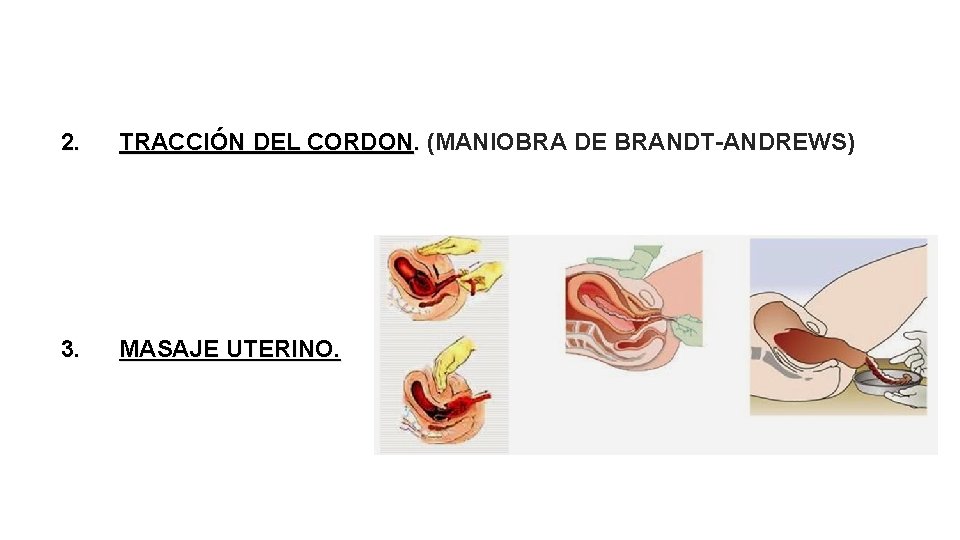 2. TRACCIÓN DEL CORDON. (MANIOBRA DE BRANDT-ANDREWS) 3. MASAJE UTERINO. 