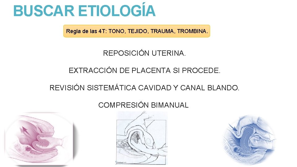 BUSCAR ETIOLOGÍA Regla de las 4 T: TONO, TEJIDO, TRAUMA, TROMBINA. REPOSICIÓN UTERINA. EXTRACCIÓN