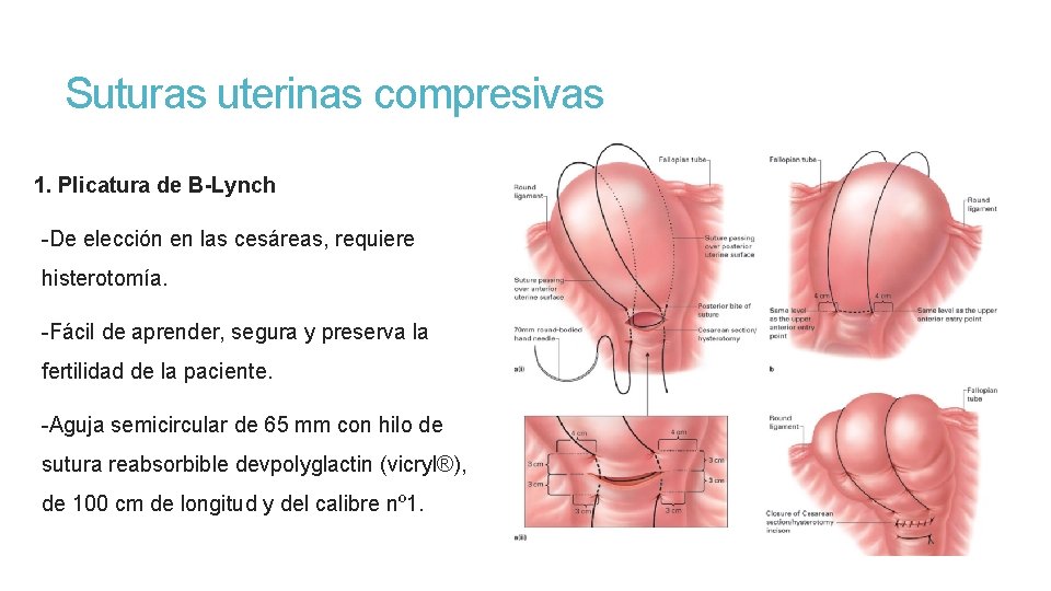 Suturas uterinas compresivas 1. Plicatura de B-Lynch -De elección en las cesáreas, requiere histerotomía.