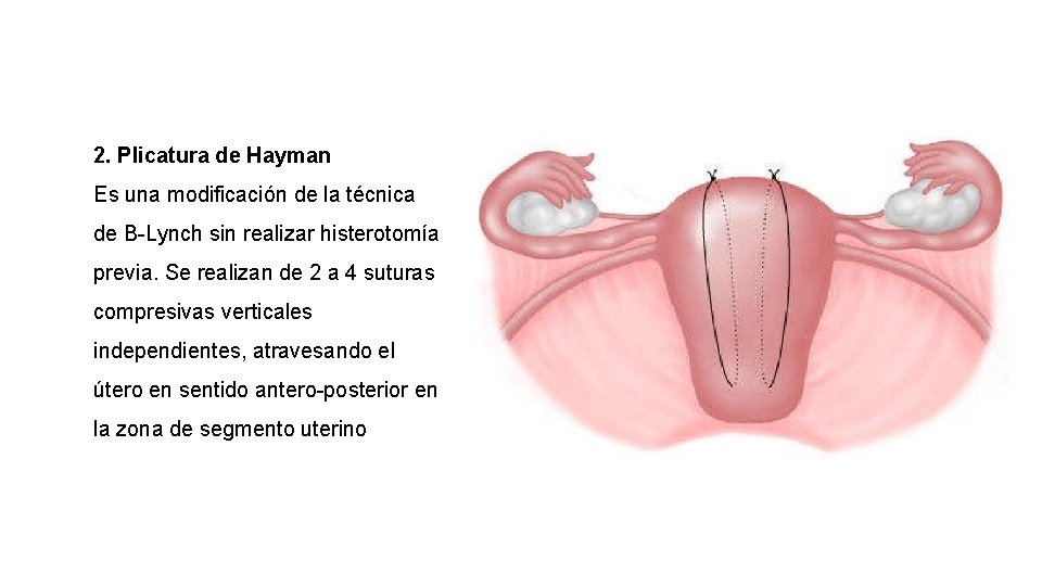 2. Plicatura de Hayman Es una modificación de la técnica de B-Lynch sin realizar