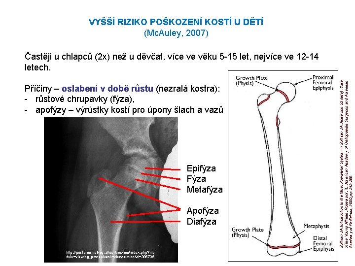 VYŠŠÍ RIZIKO POŠKOZENÍ KOSTÍ U DĚTÍ (Mc. Auley, 2007) Příčiny – oslabení v době VYŠŠÍ RIZIKO POŠKOZENÍ KOSTÍ U DĚTÍ (Mc. Auley, 2007) Příčiny – oslabení v době