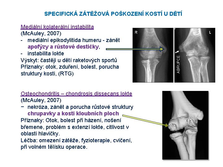 Mediální kolaterální instabilita (Mc. Auley, 2007) - mediální epikodylitida humeru - zánět apofýzy a Mediální kolaterální instabilita (Mc. Auley, 2007) - mediální epikodylitida humeru - zánět apofýzy a