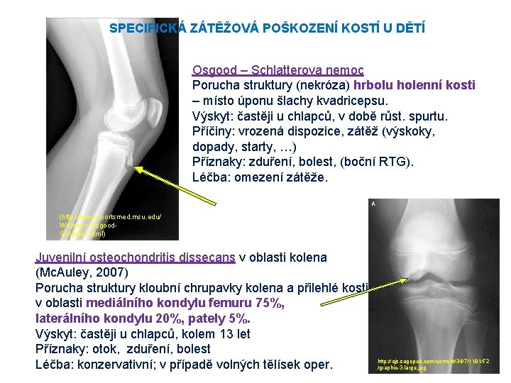 SPECIFICKÁ ZÁTĚŽOVÁ POŠKOZENÍ KOSTÍ U DĚTÍ Osgood – Schlatterova nemoc Porucha struktury (nekróza) hrbolu SPECIFICKÁ ZÁTĚŽOVÁ POŠKOZENÍ KOSTÍ U DĚTÍ Osgood – Schlatterova nemoc Porucha struktury (nekróza) hrbolu