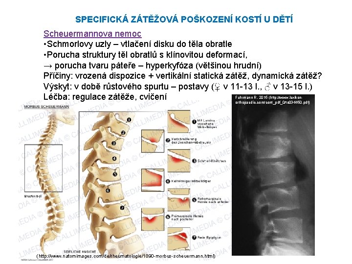 SPECIFICKÁ ZÁTĚŽOVÁ POŠKOZENÍ KOSTÍ U DĚTÍ Scheuermannova nemoc • Schmorlovy uzly – vtlačení disku SPECIFICKÁ ZÁTĚŽOVÁ POŠKOZENÍ KOSTÍ U DĚTÍ Scheuermannova nemoc • Schmorlovy uzly – vtlačení disku