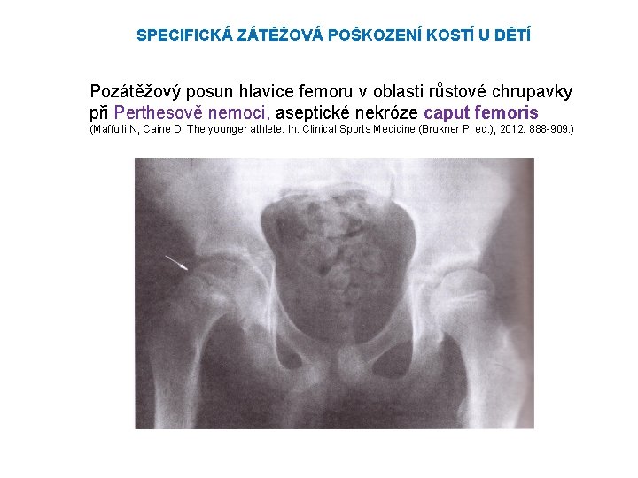 SPECIFICKÁ ZÁTĚŽOVÁ POŠKOZENÍ KOSTÍ U DĚTÍ Pozátěžový posun hlavice femoru v oblasti růstové chrupavky SPECIFICKÁ ZÁTĚŽOVÁ POŠKOZENÍ KOSTÍ U DĚTÍ Pozátěžový posun hlavice femoru v oblasti růstové chrupavky