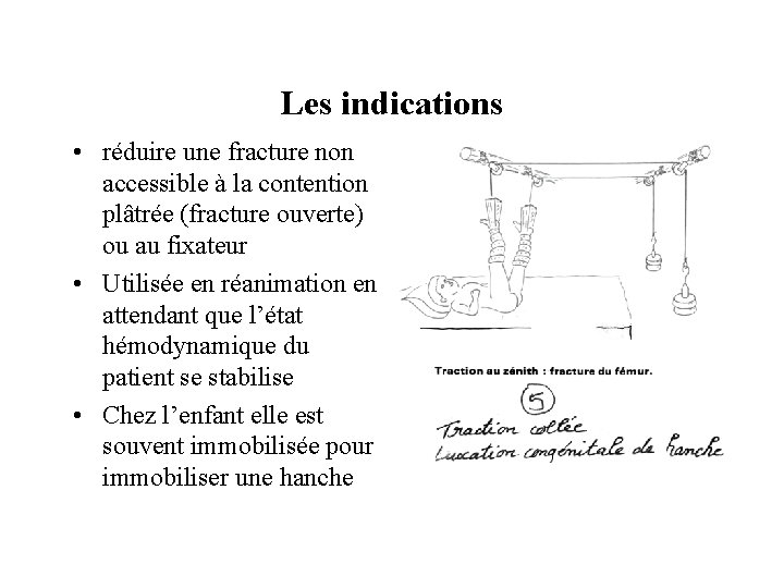 Les indications • réduire une fracture non accessible à la contention plâtrée (fracture ouverte)