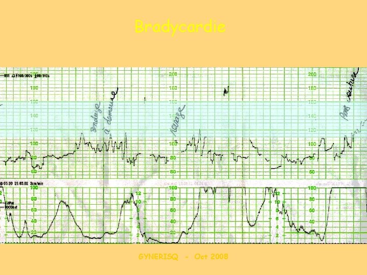 Bradycardie GYNERISQ - Oct 2008 