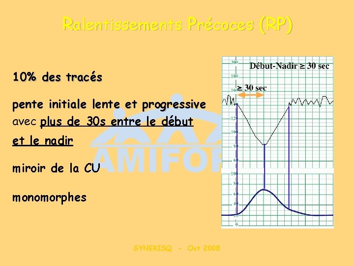 Ralentissements Précoces (RP) 10% des tracés pente initiale lente et progressive avec plus de