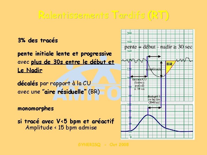 Ralentissements Tardifs (RT) 3% des tracés pente initiale lente et progressive avec plus de