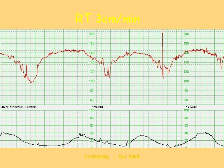 RT 3 cm/min GYNERISQ - Oct 2008 