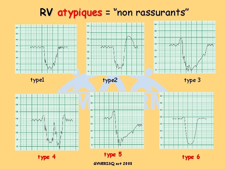 RV atypiques = ‘’non rassurants’’ type 1 type 4 type 2 type 5 GYNERISQ