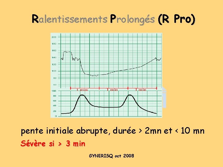 Ralentissements Prolongés (R Pro) pente initiale abrupte, durée > 2 mn et < 10