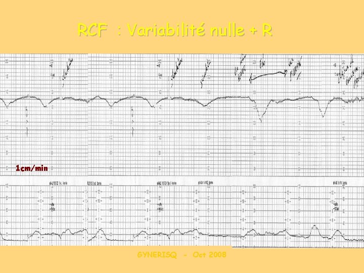 RCF : Variabilité nulle + R 1 cm/min GYNERISQ - Oct 2008 