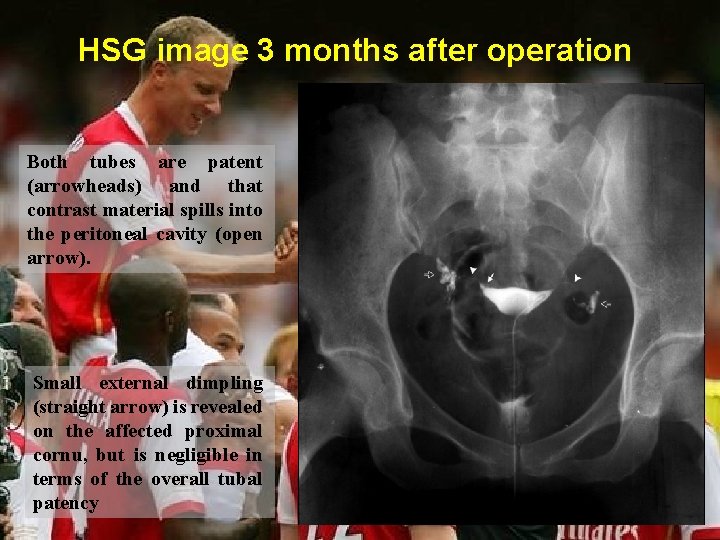 HSG image 3 months after operation Both tubes are patent (arrowheads) and that contrast