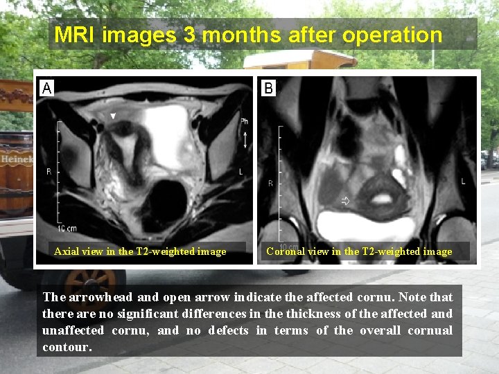 MRI images 3 months after operation Axial view in the T 2 -weighted image