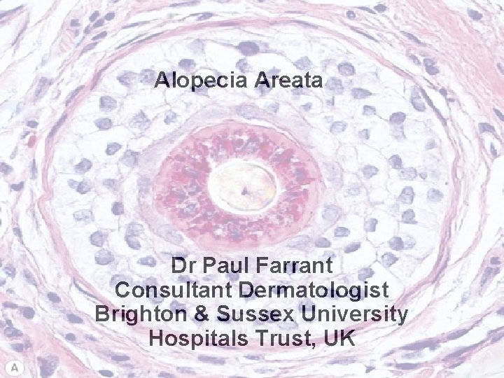 Alopecia Areata Dr Paul Farrant Consultant Dermatologist Brighton & Sussex University Hospitals Trust, UK