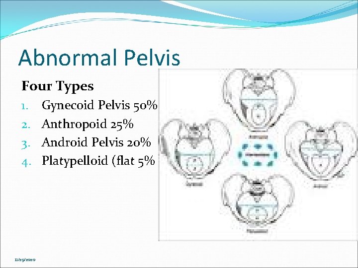 Abnormal Pelvis Four Types 1. 2. 3. 4. 11/29/2020 Gynecoid Pelvis 50% Anthropoid 25% Abnormal Pelvis Four Types 1. 2. 3. 4. 11/29/2020 Gynecoid Pelvis 50% Anthropoid 25%