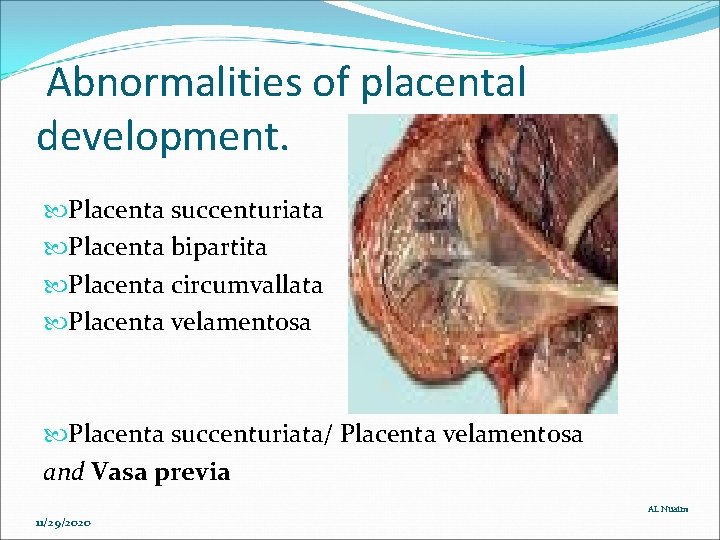 Abnormalities of placental development. Placenta succenturiata Placenta bipartita Placenta circumvallata Placenta velamentosa Placenta succenturiata/ Abnormalities of placental development. Placenta succenturiata Placenta bipartita Placenta circumvallata Placenta velamentosa Placenta succenturiata/