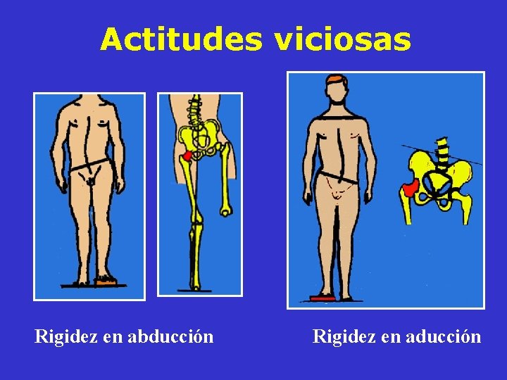 Actitudes viciosas Rigidez en abducción Rigidez en aducción Actitudes viciosas Rigidez en abducción Rigidez en aducción