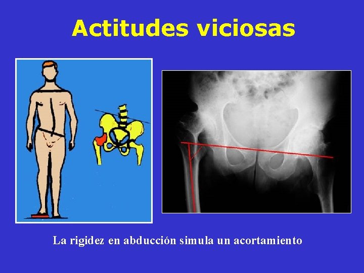Actitudes viciosas La rigidez en abducción simula un acortamiento Actitudes viciosas La rigidez en abducción simula un acortamiento