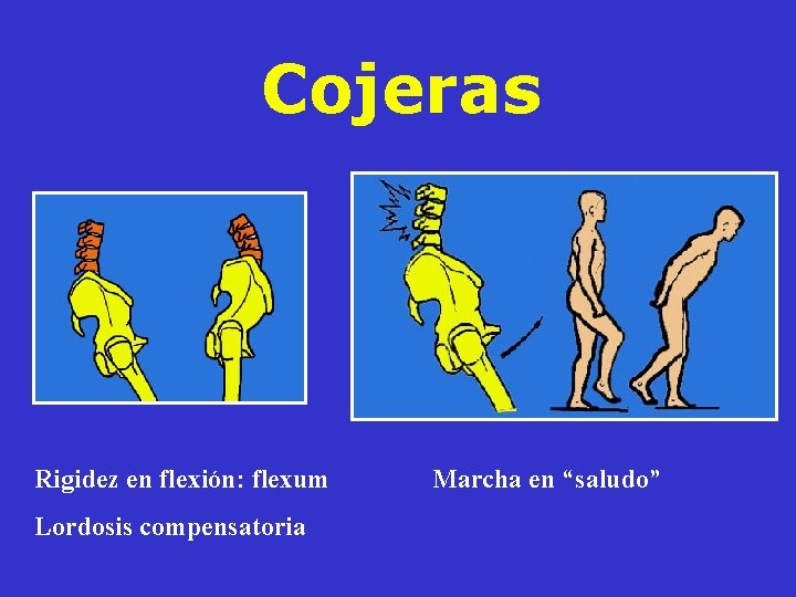 Cojeras Rigidez en flexión: flexum Lordosis compensatoria Marcha en “saludo” Cojeras Rigidez en flexión: flexum Lordosis compensatoria Marcha en “saludo”