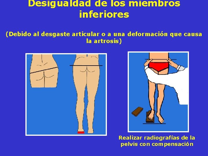 Desigualdad de los miembros inferiores (Debido al desgaste articular o a una deformación que Desigualdad de los miembros inferiores (Debido al desgaste articular o a una deformación que