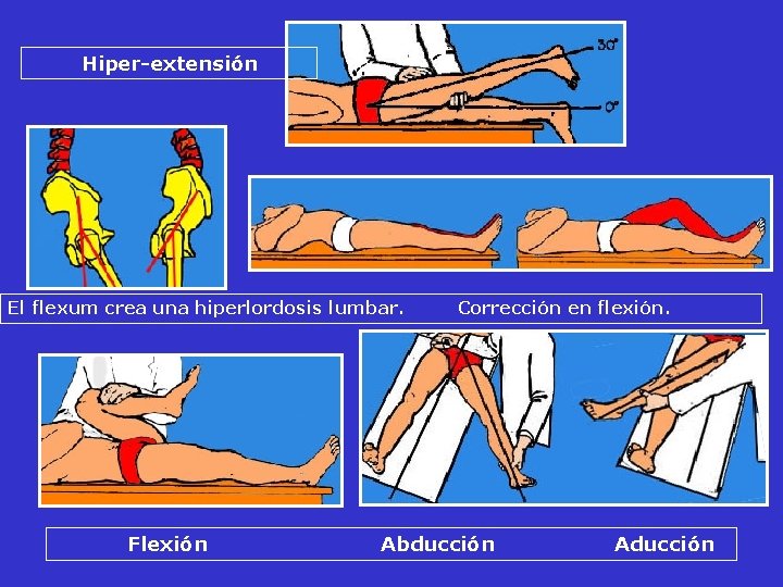 Hiper-extensión El flexum crea una hiperlordosis lumbar. Corrección en flexión. Flexión Abducción Aducción Hiper-extensión El flexum crea una hiperlordosis lumbar. Corrección en flexión. Flexión Abducción Aducción