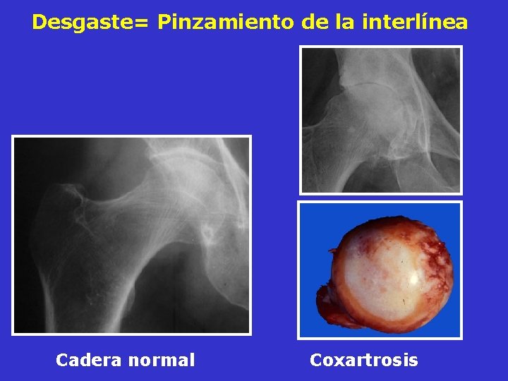 Desgaste= Pinzamiento de la interlínea Cadera normal Coxartrosis Desgaste= Pinzamiento de la interlínea Cadera normal Coxartrosis