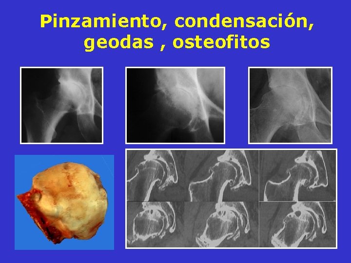 Pinzamiento, condensación, geodas , osteofitos Pinzamiento, condensación, geodas , osteofitos
