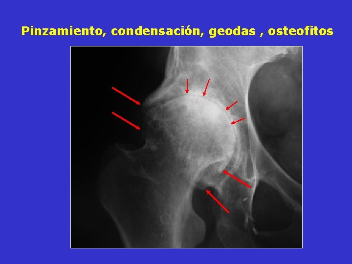 Pinzamiento, condensación, geodas , osteofitos Pinzamiento, condensación, geodas , osteofitos