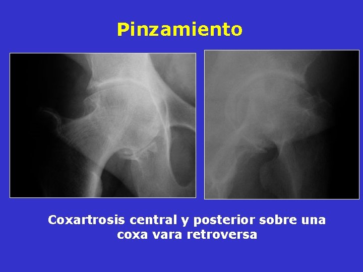 Pinzamiento Coxartrosis central y posterior sobre una coxa vara retroversa Pinzamiento Coxartrosis central y posterior sobre una coxa vara retroversa