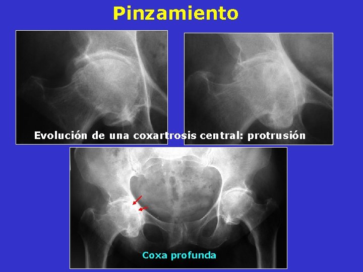 Pinzamiento Evolución de una coxartrosis central: protrusión Coxa profunda Pinzamiento Evolución de una coxartrosis central: protrusión Coxa profunda