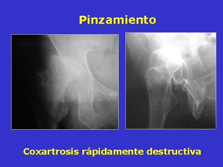 Pinzamiento Coxartrosis rápidamente destructiva Pinzamiento Coxartrosis rápidamente destructiva
