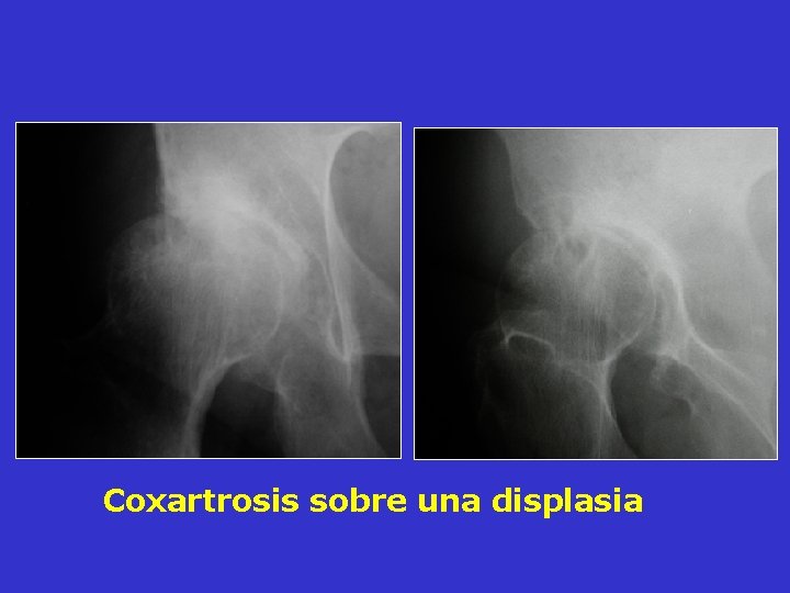 Coxartrosis sobre una displasia Coxartrosis sobre una displasia