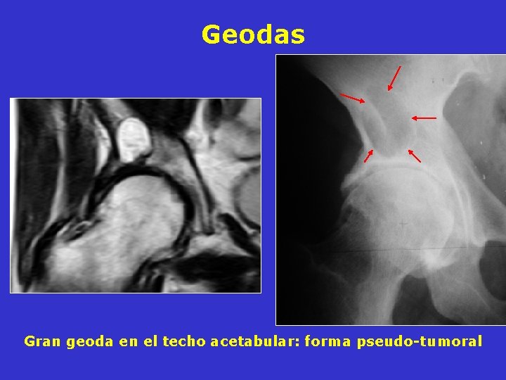 Geodas Gran geoda en el techo acetabular: forma pseudo-tumoral Geodas Gran geoda en el techo acetabular: forma pseudo-tumoral