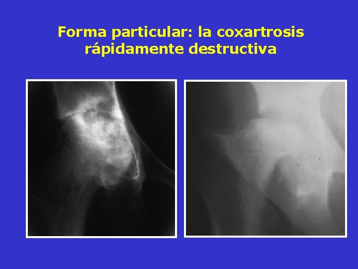 Forma particular: la coxartrosis rápidamente destructiva Forma particular: la coxartrosis rápidamente destructiva