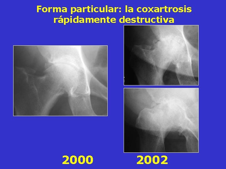 Forma particular: la coxartrosis rápidamente destructiva 2000 2002 Forma particular: la coxartrosis rápidamente destructiva 2000 2002